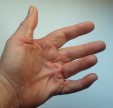 Am kleinen Finger und Ringfinger haben sich deutliche Stränge gebildet. Die Finger lassen sich nicht mehr strecken.